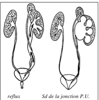 Figure 9 : Pathologie de reflux et syndrome de jonction. 