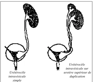 Figure 11 : Urétérocèles ectopiques. 