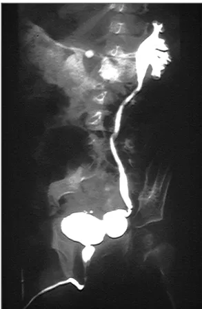 Figure 1 : Diverticule para-urétéral de HUTCH avec reflux vésico-urétéral gauche de grade II 