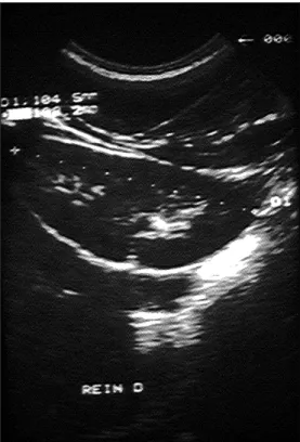 Figure  3  :  Duplication  rénale,  le  bassinet  est  barré par  une  colonne  de  BERTIN,  hypertrophie  d'aspect pseudo- pseudo-tumoral  