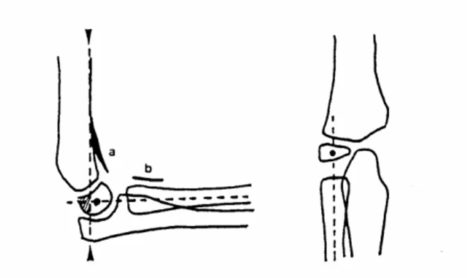 Figure 3 : Aspect normal du coude: liseré coronoïdien (a), liseré du court supinateur (b), la  ligne humérale antérieure ( ) passe en arrière du tiers antérieur du noyau condylien, l'axe  du  radius  passe  au  centre  du  noyau  condylien  de  face  et  d