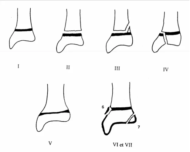 Figure 2 : Différents types de fractures épiphyso-métaphysaires selon Salter-Harris et Ogden 