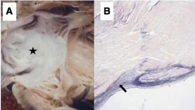 Figure  2  Endocardial  fibroelastosis  in  BTHS.  (A)  The  endocardium  appears  abnormally  pale (starred) and (B) there is marked thickening (arrowed) of the endocardial surface on the  corresponding photomicrograph (Van Gieson staining)