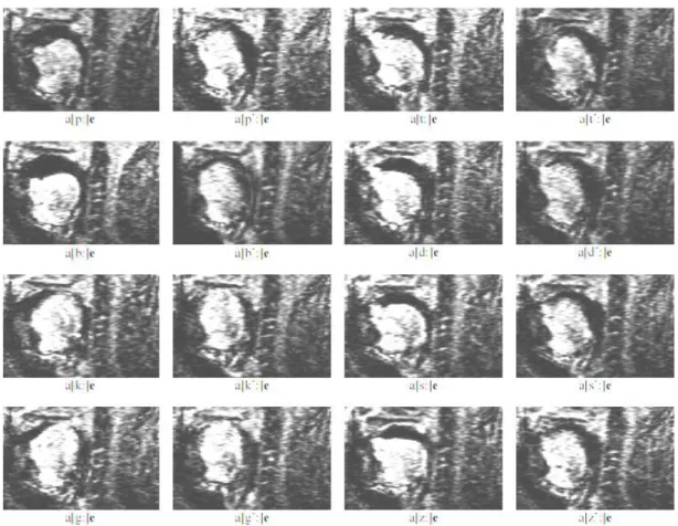 Figure 7 : Images obtenues en IRM par Kedrova et al. (2008).