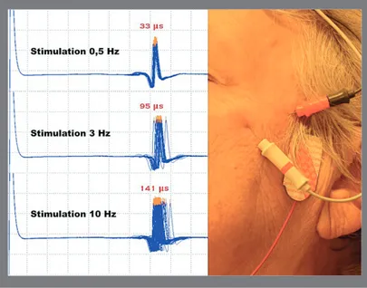 Figure 3. Résultats de la stimulation nerveuse répétitive chez une patiente  myasthénique (à droite).
