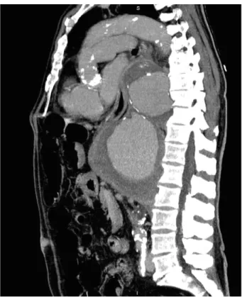 Figure 1 : Coupe sagittale de scanner montrant l’anévrisme bissaculaire de l’aorte thoracique.