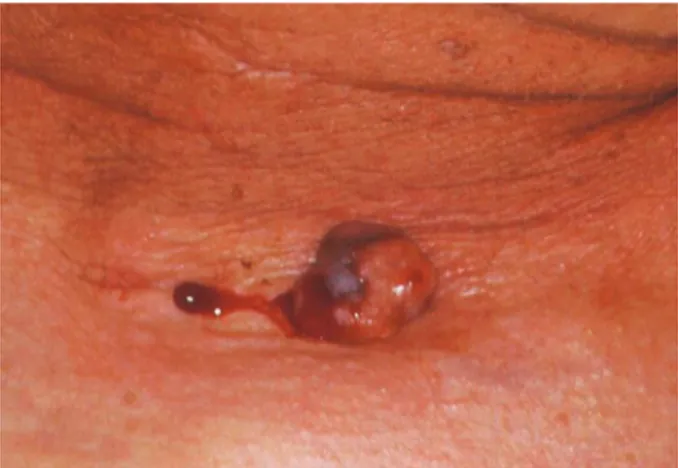 Fig. 3 : Dépôts de mélanine intratumoraux et dans le stroma conjonctif avoisinant
