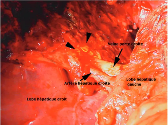 Fig. 3. Perfusion du lobe hépatique droit “ex vivo” par la solution UW à travers la veine porte droite.