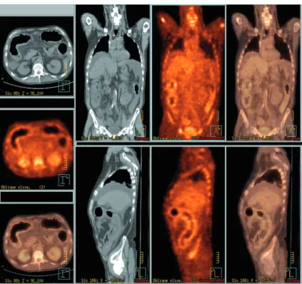 Figure : 2 : Muqueuse rectosigmoïdienne montrant d’importants dépôts floconneux teintés de bile.