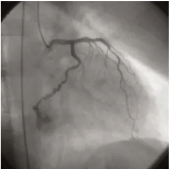 Fig. 2. Fistule entre une mégaartère coronaire droite et le sinus coro- coro-naire (séquence précoce).