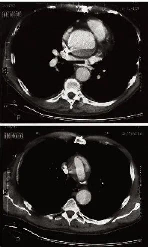 Fig. 1 a et b. Aspect tomodensitométrique d’une dissection aiguë de l’aorte ascendante, incluant l’arche aortique, sur une aorte  préala-blement dilatée.