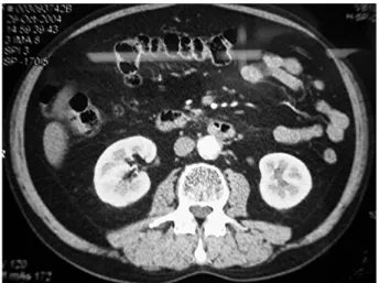 Fig. 2. Contrôle du CT-scanner après 6 mois d’évolution sous traite- traite-ment cortisonique