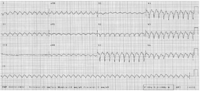 Figure 2. ECG post-cardioversion. Tachycardie sinusale à 150/min. Les ondes P sont bien visibles dans les dérivations V5 et V6
