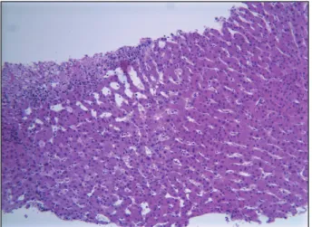 Figure 2. Coupe foie-coloration éosine-agrandissement 400 fois - infiltration  inflammatoire avec nécrose hâpatocyaire - image des noyaux des hépatocytes  en verre dépoli : signe d’infection virale.