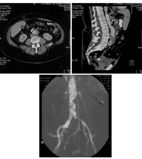 Fig. 1. Transverse (Top left) and sagittal (Top right) CT scans show an aneurysm of the infrarenal aorta with parietal thrombus.