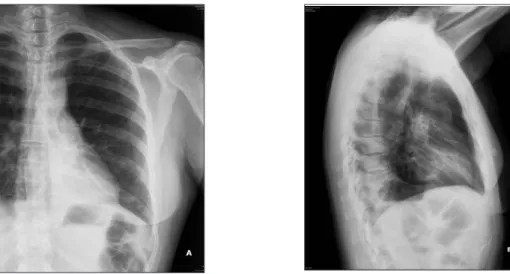 Figure 1 A, B. Radiographie thoracique de la patiente. A l’admission, foyer de condensation postéro-basale gauche