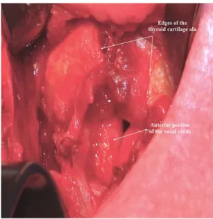 Fig. 2. Indirect laryngoscopy showing implant extrusion on the left vocal fold. [Color figure can be viewed in the online issue, which is available at www.laryngoscope.com.]