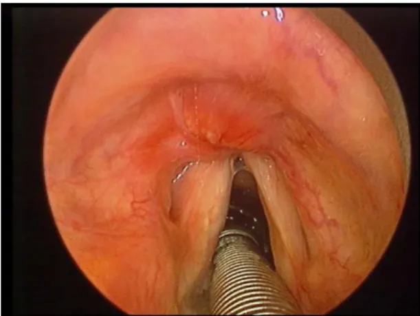 Fig. 6. External approach. (A) Anterior partial resection of the thy- thy-roid cartilage