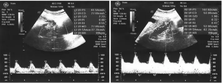 Figure 1 Normal left and right uterine arteries at 24 weeks’ gestation (no notch sign).