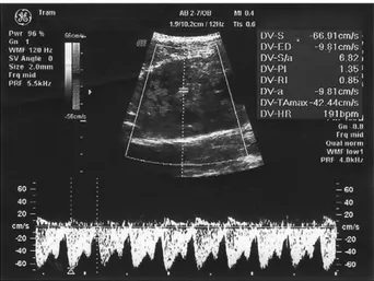 Figure 3 Normal Doppler velocimetry of the middle cerebral artery at 24 weeks’ gestation (no notch sign, normal pulsatility index [PI] and resistance index [RI]).