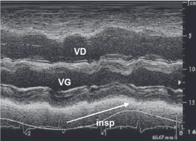 Figure 1 : Echocardiographie en mode-TM montrant une dilatation  nette du ventricule droit (VD) qui se marque davantage lors de  l’ins-piration (insp)