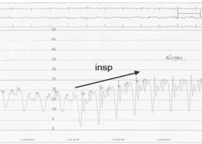 Figure 5 : Profil de pression enregistré dans l’oreillette droite. La  valeur, élevée à l’état basal augmente à l’inspiration profonde (insp)