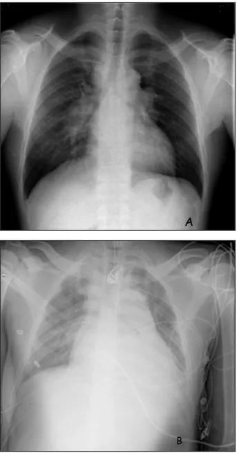 Figure  1.  Comparaison  des  clichés  de  radiographie  thoracique. A.  Cliché  réalisé lors du diagnostic de sarcoïdose pulmonaire (2 mois auparavant)  B