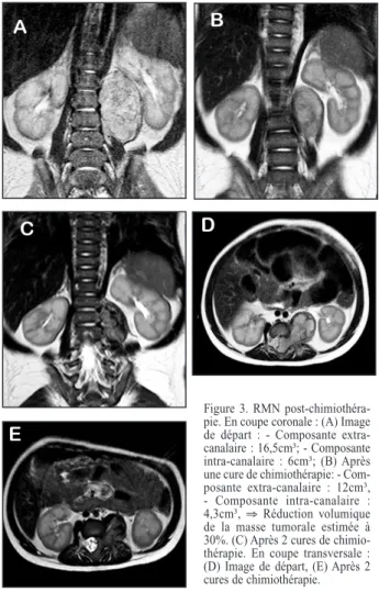 Figure 2. RMN en coupe coronale (A) et sagittale (B) en pondération T2  après injection de gadolinium