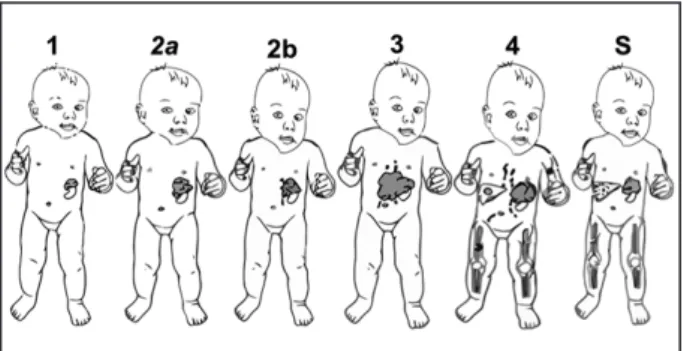 Figure 4. Illustration du Système de Stadification International du Neuroblas- Neuroblas-tome (INSS)