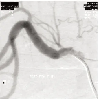 Fig. 3. Comparaison des adaptations dans deux types d'hypertension artérielle rénovasculaire : sténose  bilaté-rale (ou sur rein unique) (gauche) et sténose unilatébilaté-rale d’artère rénale (droire).