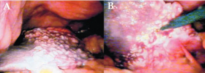 Fig. 5. — Gross photography of the resected liver section, showing a solid, white mass with spongy, microcystic aspect.