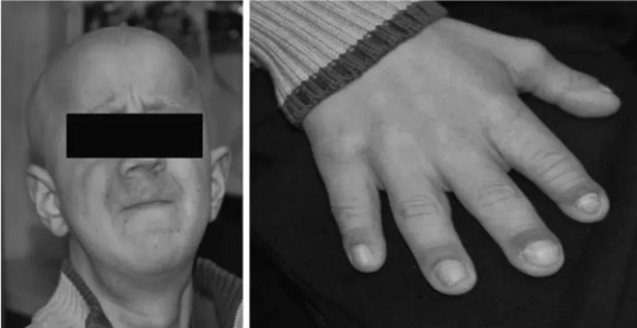 FIGURE 1. Our patient aged 22 years, his hand with short fingers.