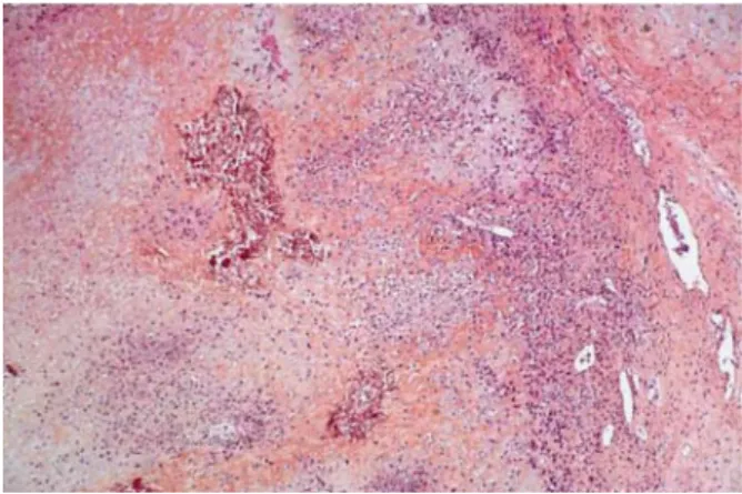 FIGURE 4. Pathology of the tumor (HES 50): the tumor is cellular, mainly composed of an immature chondroblastic  com-ponent, focally necrotic, and calcified with minimal osteoblastic areas.