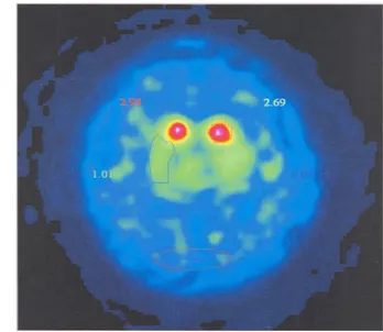 Figure 2. DaT-SPECT (Single Photo Emission Computed Tomography).