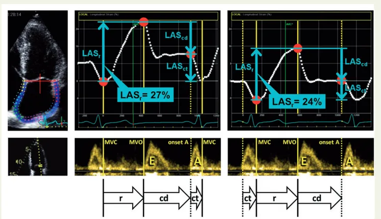 Figure 1 Measurement of left atrial strain components. Left panel: with the zero strain reference at end-diastole (recommended), right panel: with zero strain reference at the onset of atrial contraction