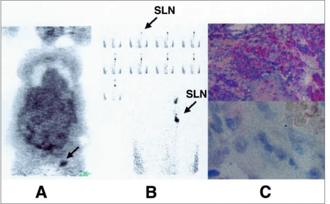 Figure 1. A case of malignant melanoma of the left foot (Breslow’s depth = 4.5 mm).  18 FDG PET imaging (A) accurately detected an involved sentinel node harvested at the left groin (B)