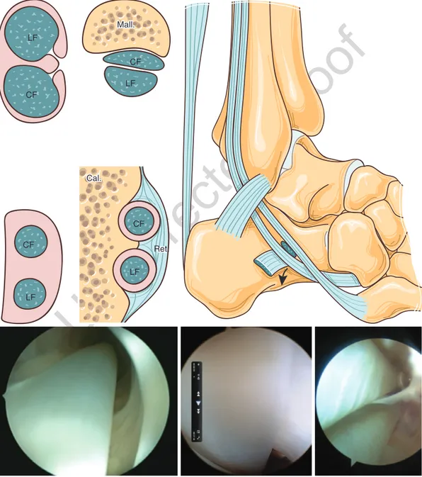 Fig. 2.3  Arthroscopic anatomy. Layered sections of the different areasCFLFCFMall.LFCFLFCal.CFLFvaRet.909192939495969798 99 100101102103104105106107