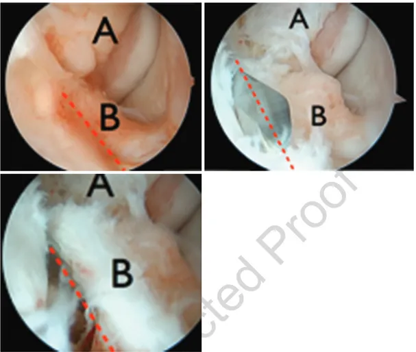 Fig. 3.5  Lateral gutter dissection: visualization of the distal part of the Basset ligament (a) and superior bundle of the  ATFL (b)