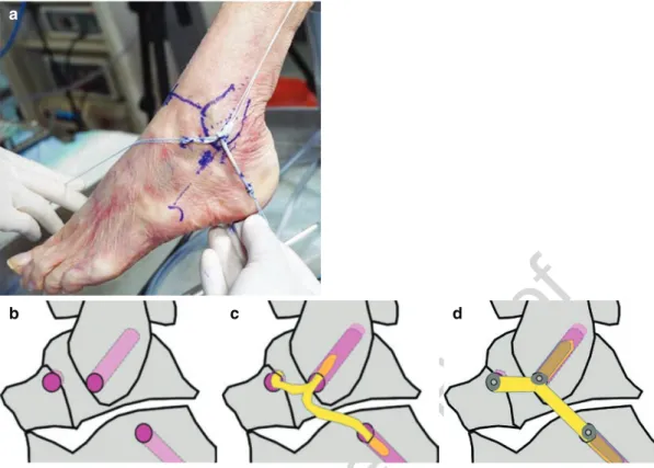 Fig. 4.13 Portals. MML medial midline portal, AAL  accessory anterolateral portal, ST subtalar portal