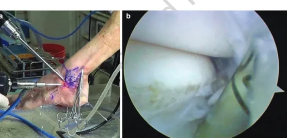 Fig. 4.18  Make a calcaneal bone tunnel. (a) A viewing portal is ST and a working portal is AAL