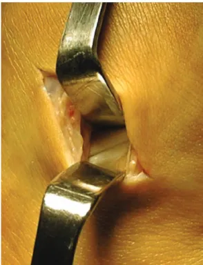 Fig. 5.6  Second suture: the needle is passed through the  calcaneofibular ligament