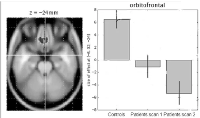 Figure 2 :FDG-TEP chez des sujets sains et des migraineux souffrant de CAA avant (scan1) et après (scan 2) sevrage médicamenteux