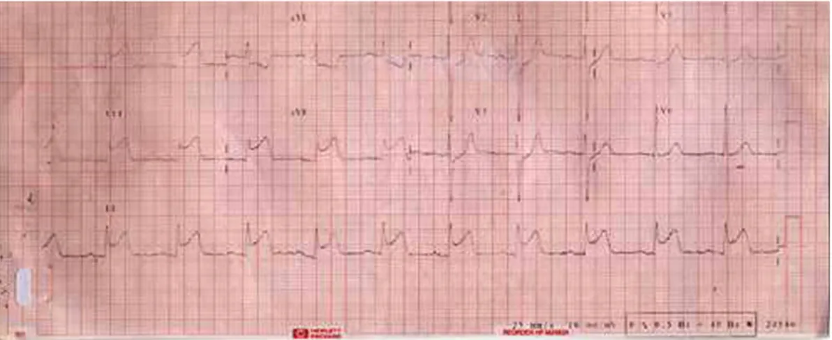 Fig. 1. ECG In the intensive care unit: appearances of acute inferior myocardial infarction.