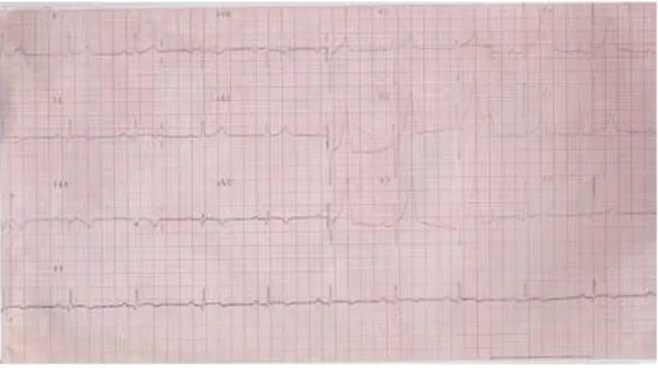 Fig. 2. ECG: rapid resolution of ST segment elevation after perfusion of intravenous tissue plasminogen activator.