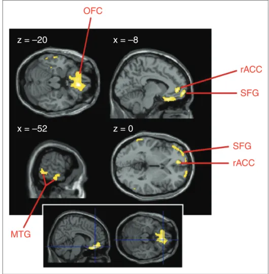 Figure 2. Hypometabolic areas in patients with episodic migraine compared to healthy individuals (p&lt; 0.001 uncorrected, 20 voxels;