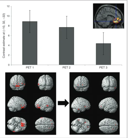 Figure 3. Top: Effect size (normalised values) at the peak voxel (i.e. orbitofrontal cortex, OFC) for the parametric analysis in seven patients who were headache free the day of the scan (controlled for age and gender), representing the increases in metabo