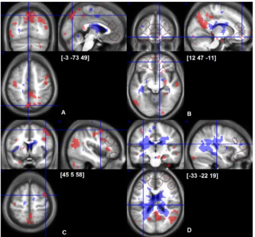 Fig. 4. Cerebral responses to early (shaded areas with back dots) and sustained (shaded areas with white dots) cold-induced pain