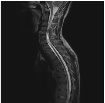 Figure 2 Axial CT scan with bone window showing an osteo- osteo-chondroma measuring 22 mm in anteroposterior length and 17 mm in width, developing at the expense of the posterior arch of C4 and entering the spinal canal.