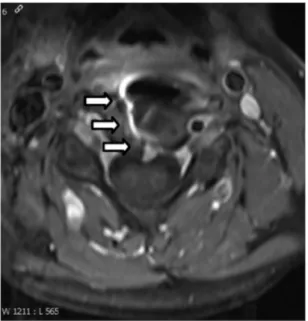 Fig. 2. T1 weighted MRI sequences with gadolinium in the axial plan show prever- prever-tebral contrast enhancement at the level of interdiscal space C3/4.