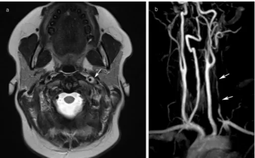 Fig. 2. Pedigree; In grey member of the family heterozygous of the c.953G &gt; A (p.Gly318Asp) mutation in the exon 14 of COL3A1 gene, II:1; Type A aortic dissection, III:1; Cervical artery dissections, II:2; heterozygous asymptomatic mutation carrier, I:1